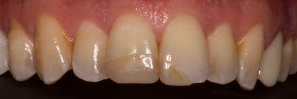 before chipped teeth