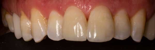 after dental procedure