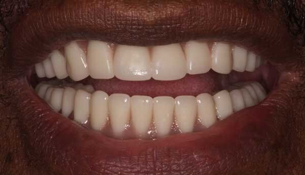 after teeth image