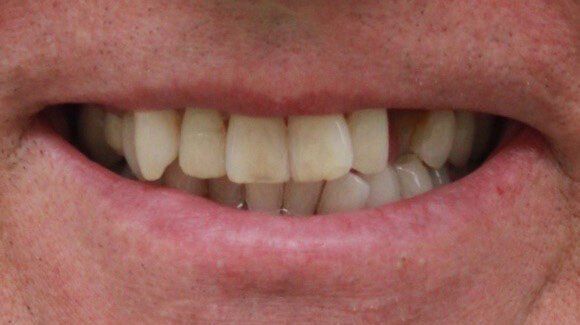 before misaligned teeth