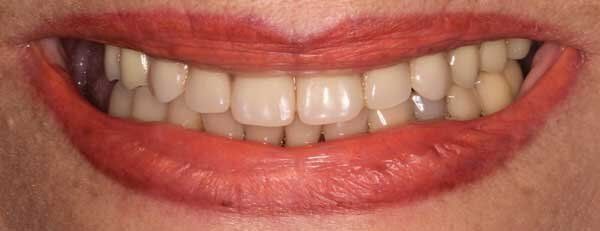 after image of teeth