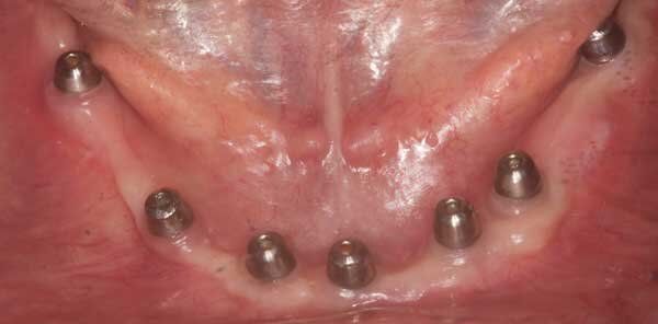 before dental procedure