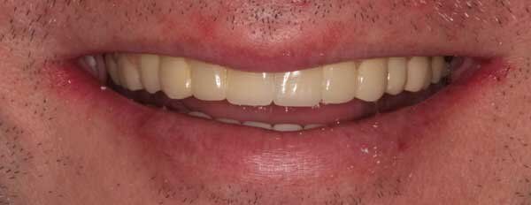 after aligned teeth