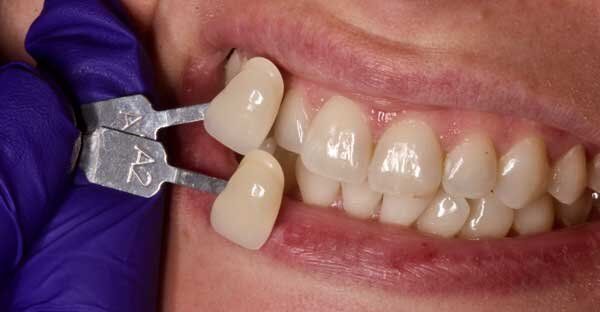 before with two teeth