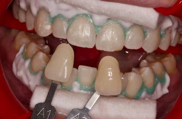 after with two separate teeth