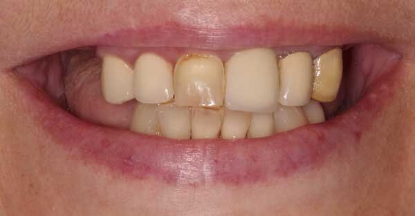 before tooth discoloration