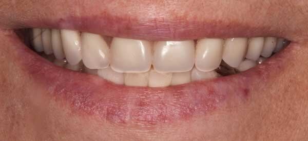 after tooth discoloration