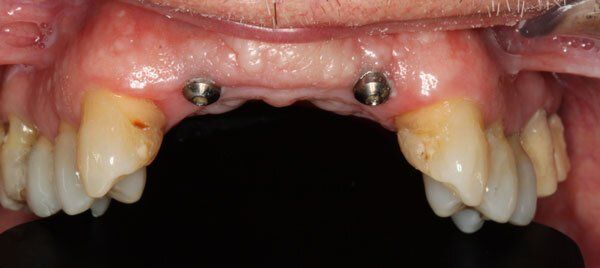 before without teeth