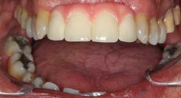 after mouth wide open showing teeth