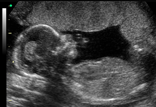 Fetal ultrasound scan showing a side profile of a baby in the womb, with the head and body visible.