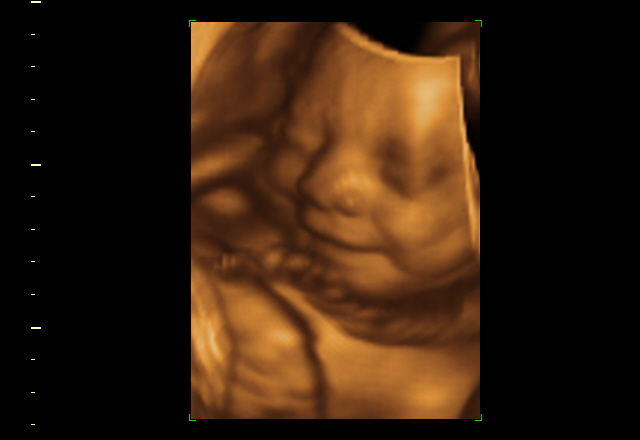 3D ultrasound scan of a fetus, showing a profile view with face, nose, and upper body visible in brown tones.