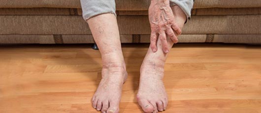 Varicose Vein