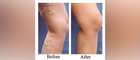 Varicose Vein Before After