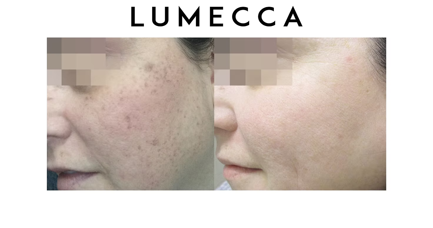 Side-by-side close-up skin photos showing red acne spots on a cheek, labeled LUMECCA.
