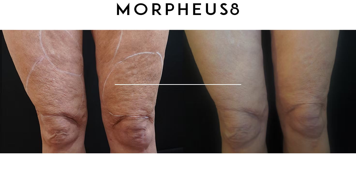 MORPHEUS8 treatment results showing close-up of skin before and after on legs or arms