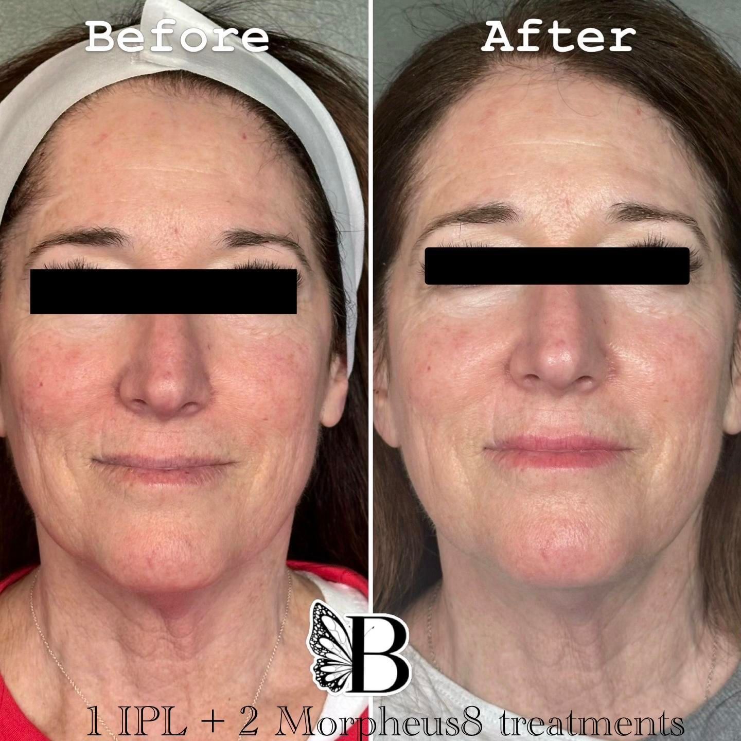 Before-and-after facial treatment comparison, showing reduced redness and finer skin texture after IPL and Morpheus8.