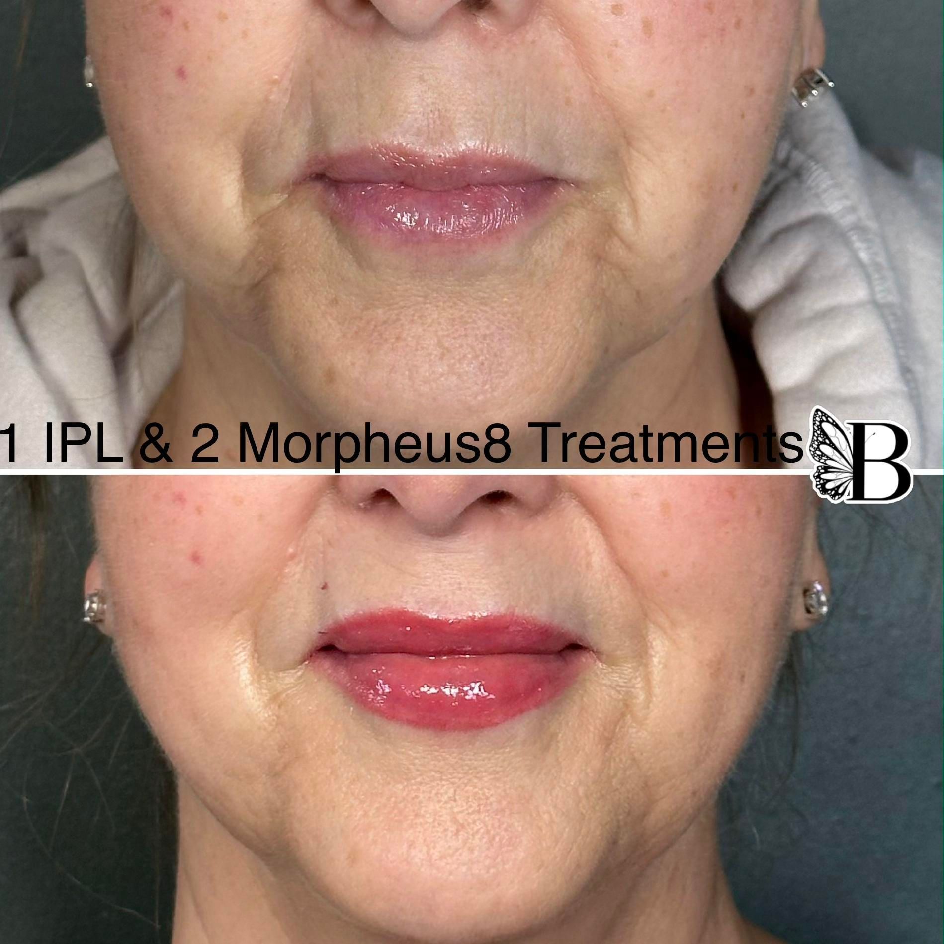 Before-and-after close-up of a face, showing smoother skin and fuller lips after IPL and Morpheus8 treatments