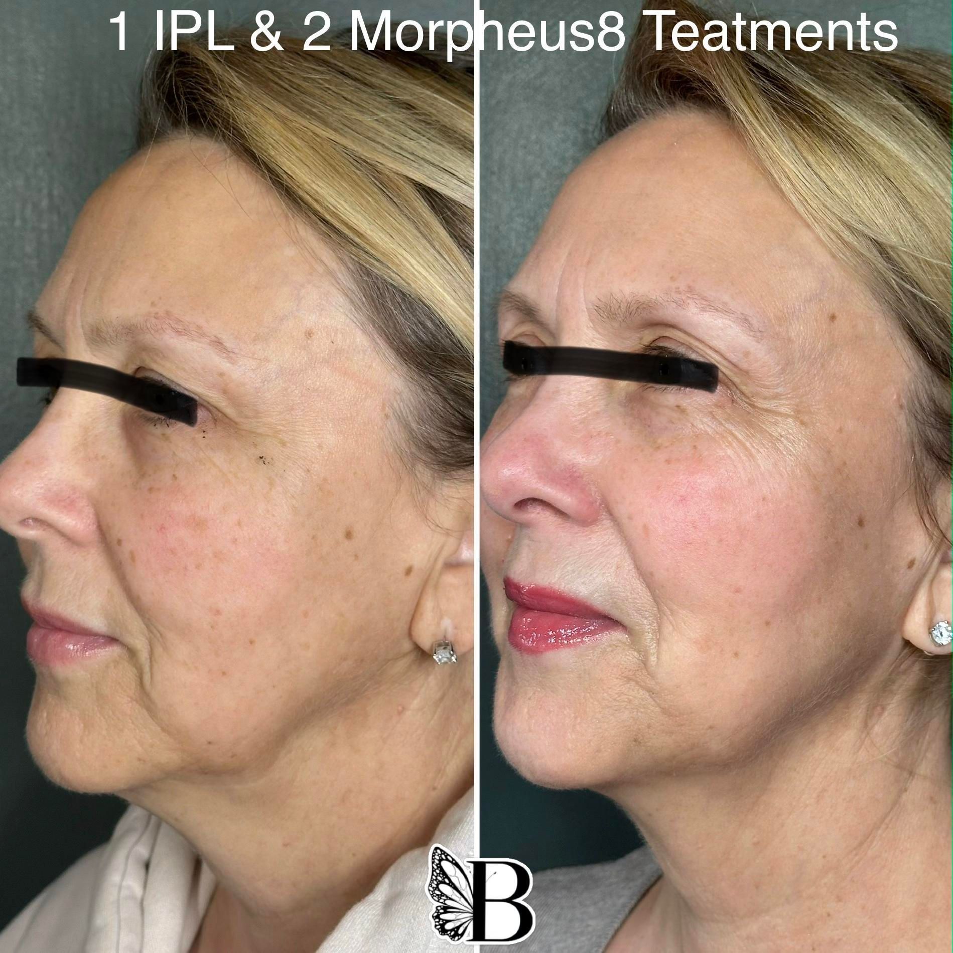 Side-by-side facial profile comparison showing improved skin after IPL and Morpheus8 treatments
