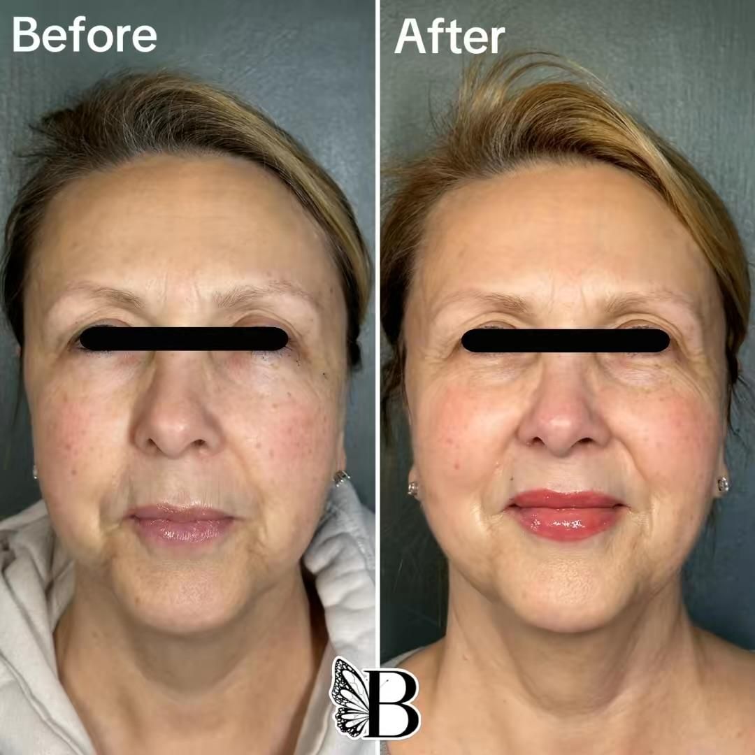 Before-and-after face comparison showing smoother skin, brighter complexion, and fuller lips after treatment.