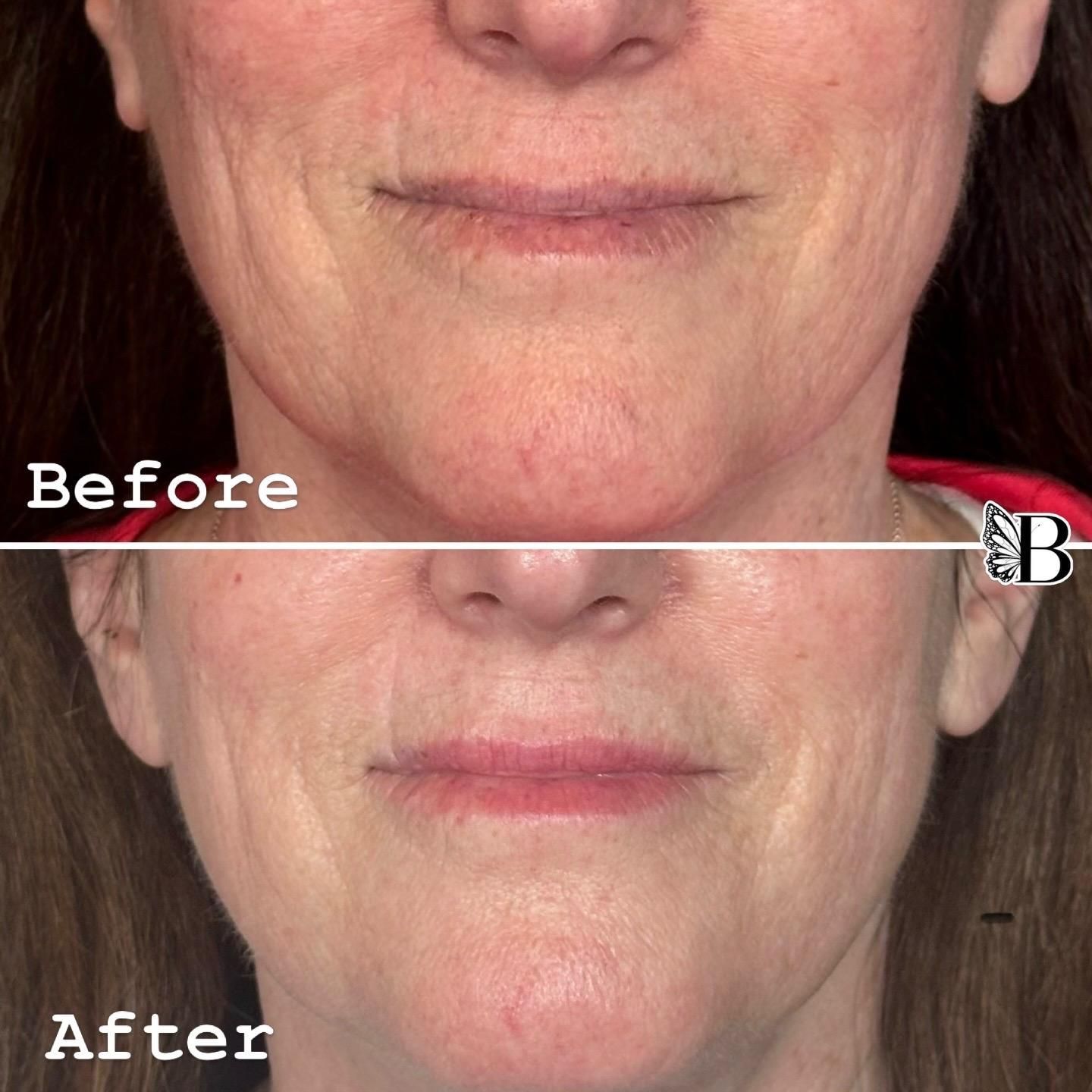 Before-and-after close-up of lower face showing smoother skin and reduced lines after treatment.