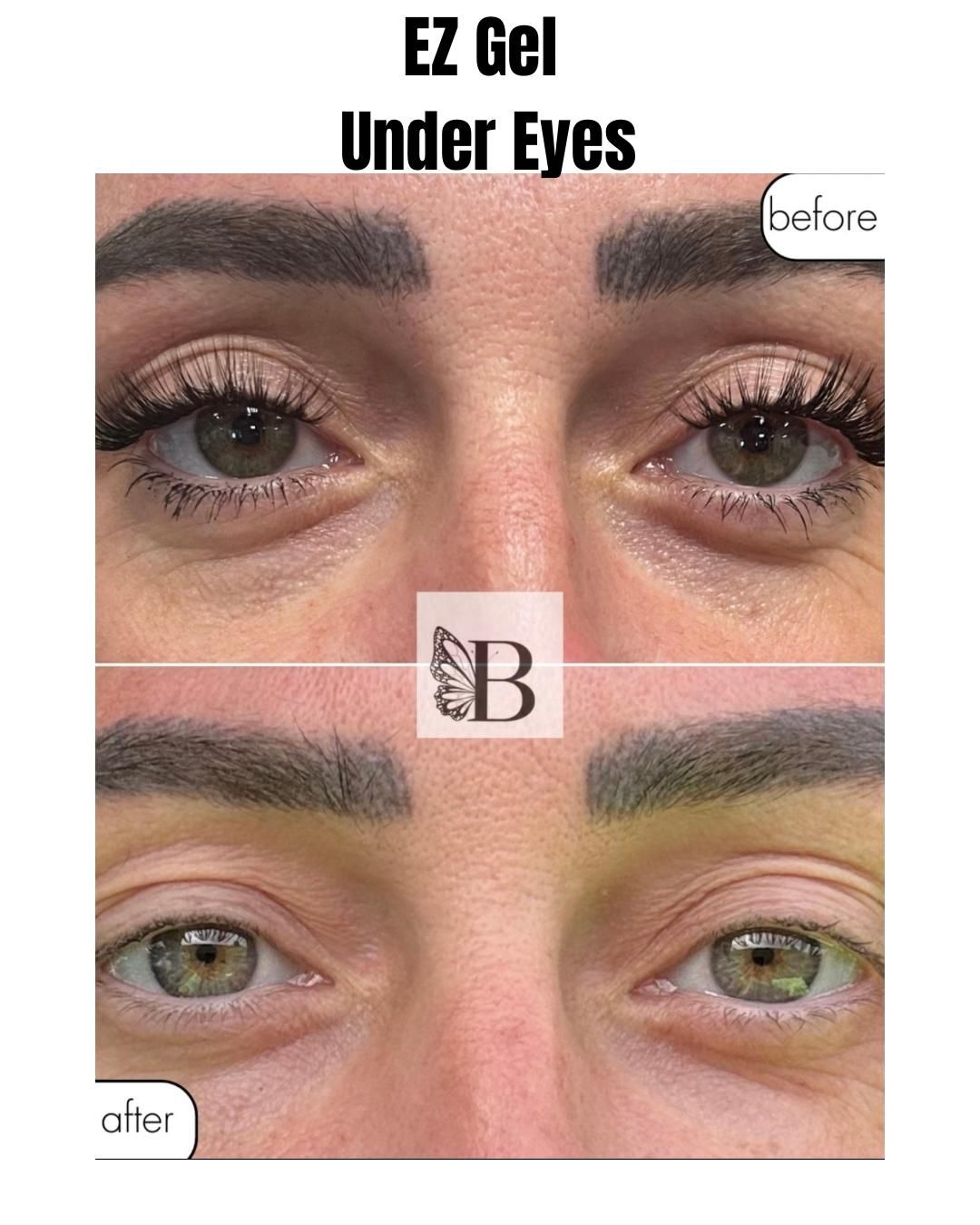 Before-and-after under-eye gel ad showing reduced puffiness and brighter skin under the eyes.