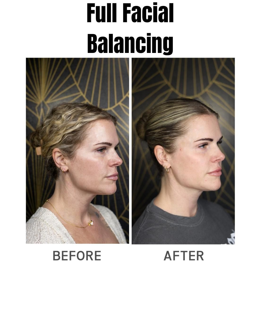 Before-and-after facial balancing comparison showing a side profile change, labeled “BEFORE” and “AFTER.”