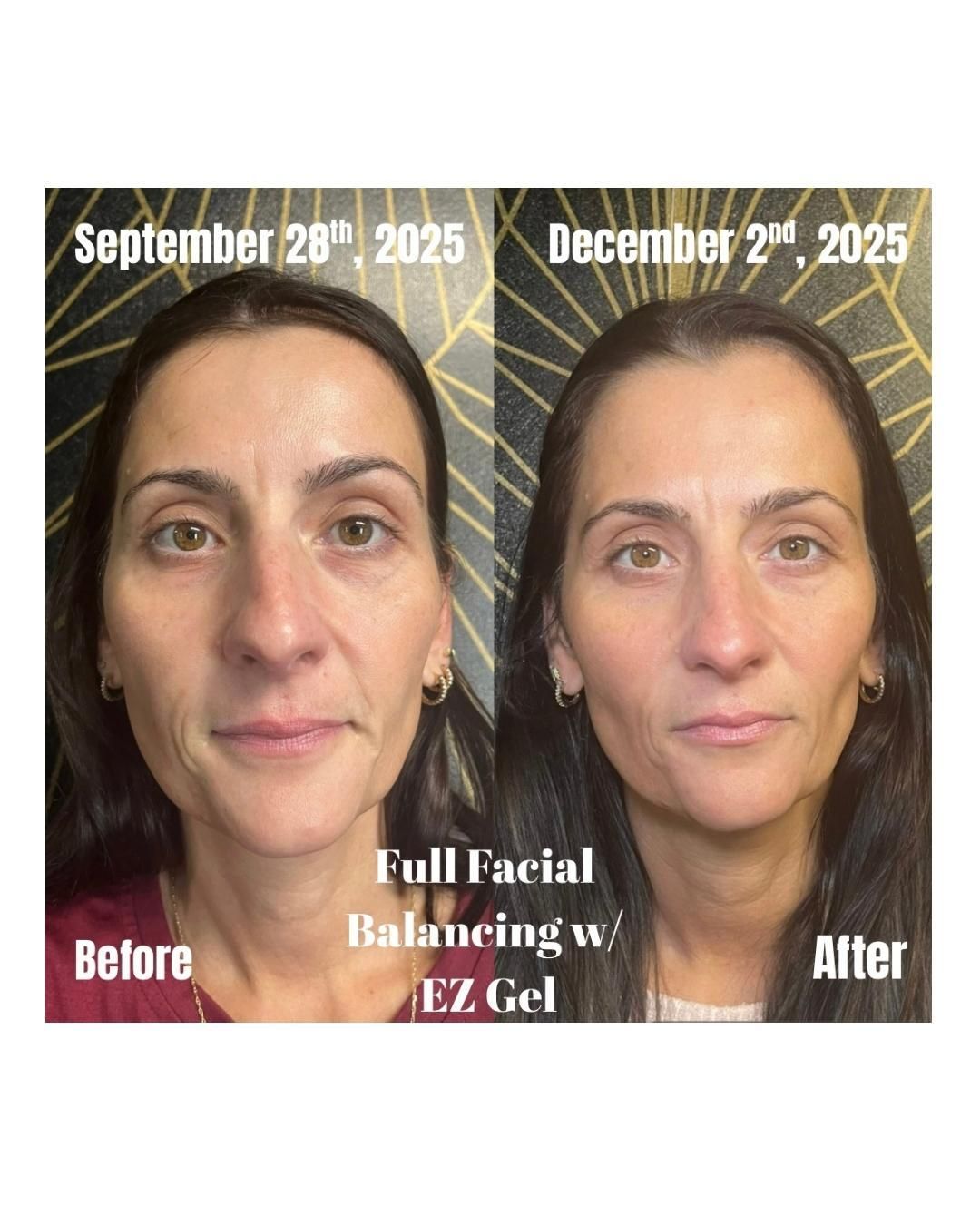 Before-and-after facial treatment photos with centered text, showing a woman’s face under warm lighting.