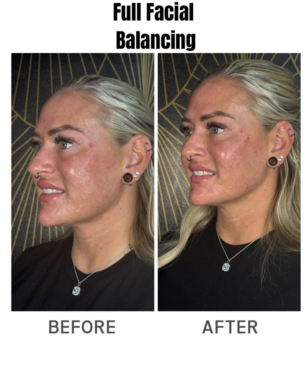 Before-and-after facial balancing photos of a woman, showing side profiles with improved facial symmetry.