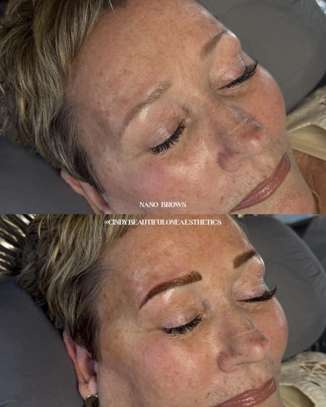 Before-and-after close-up of a woman’s face showing smoother skin and eyebrows after cosmetic treatment