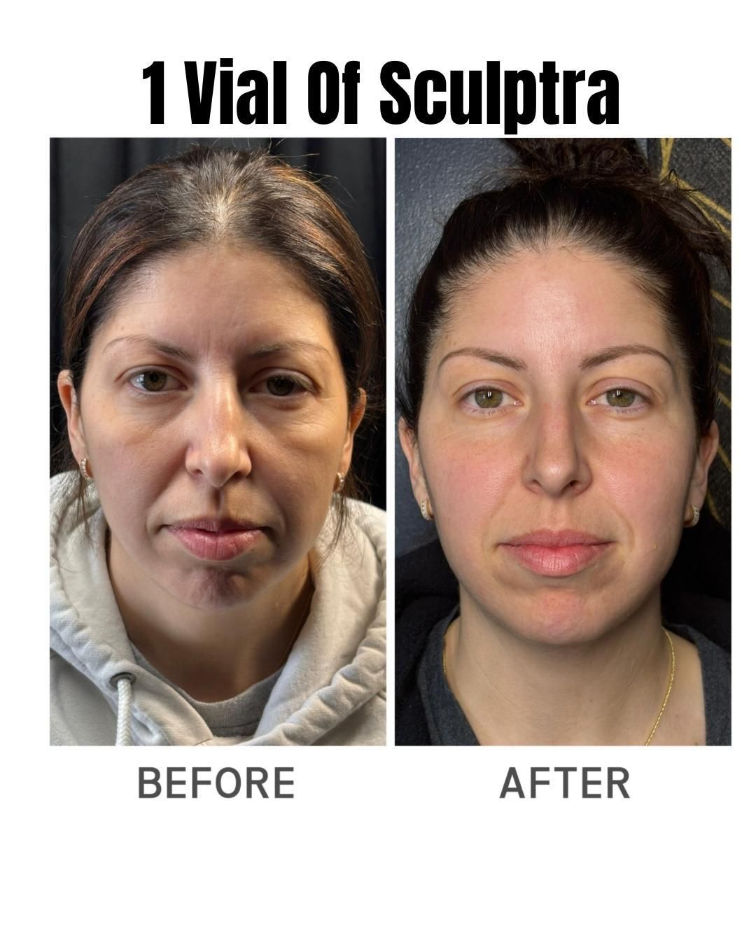 Before-and-after facial photos labeled “1 Vial Of Sculptra.”