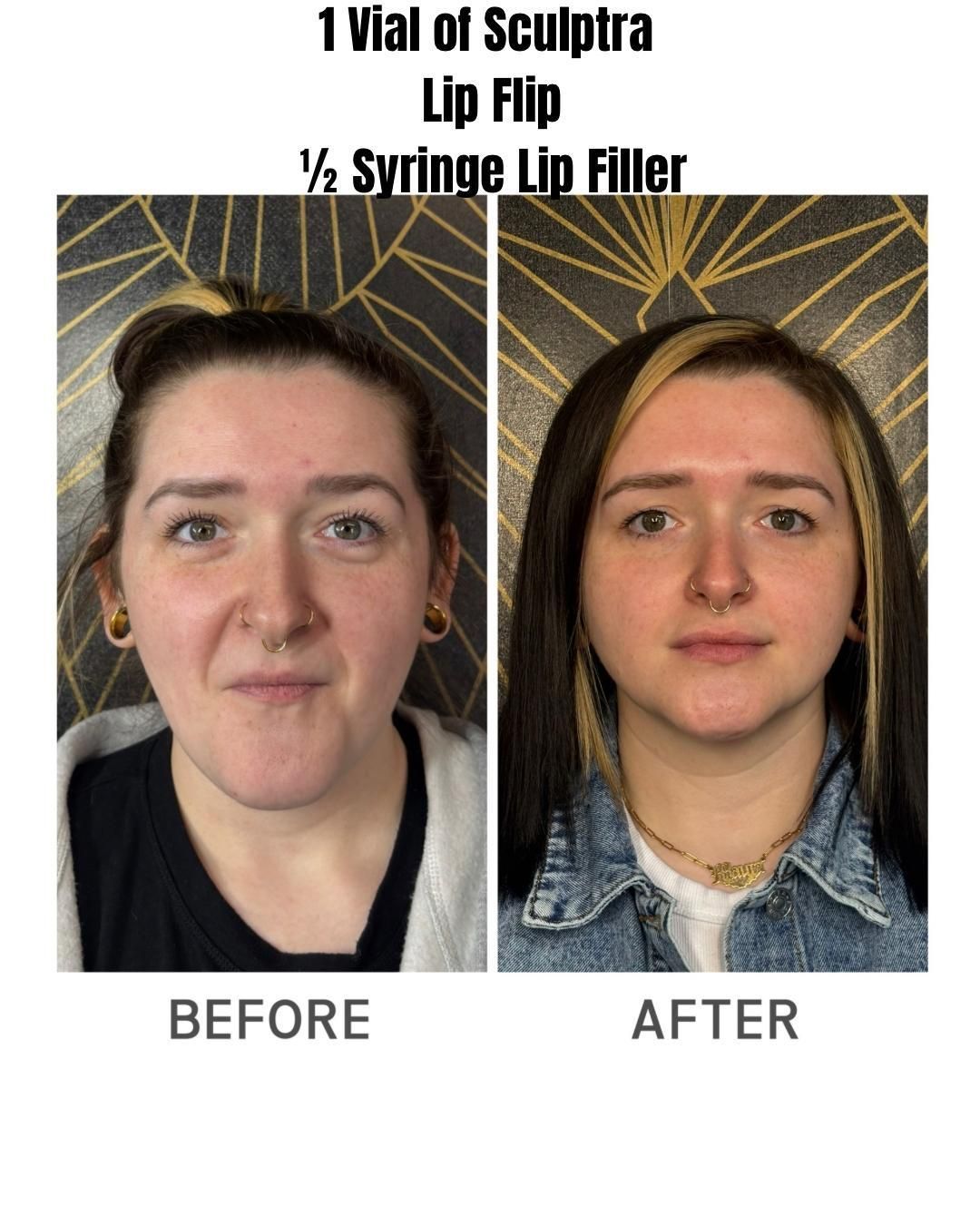 Before-and-after portrait showing face changes after Sculptra and lip filler treatment.