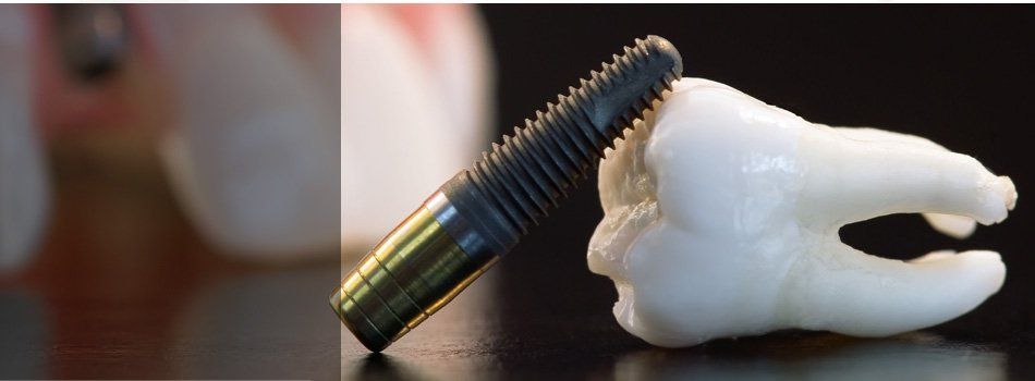 A wisdom tooth dental implant