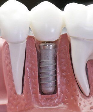 Sample of dental implant