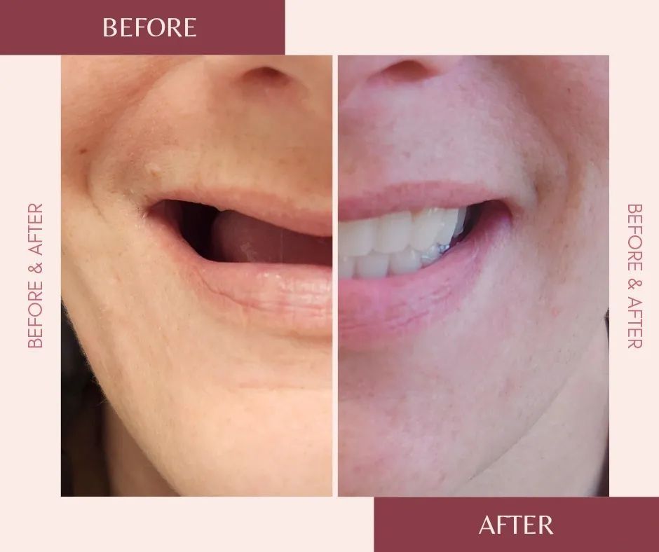 Before-and-after close-up of a mouth, showing a smile transformation with labels “BEFORE” and “AFTER”