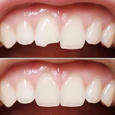 before and after photo of a repaired chipped tooth
