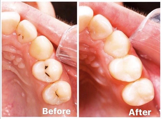 Sickening moment dentist finds dozens of live MAGGOTS wriggling between  patient's teeth