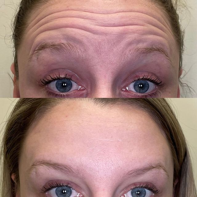 botox