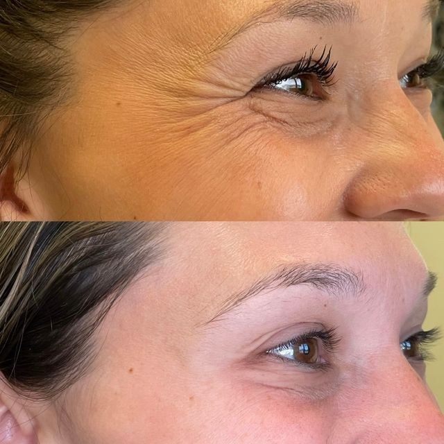 botox