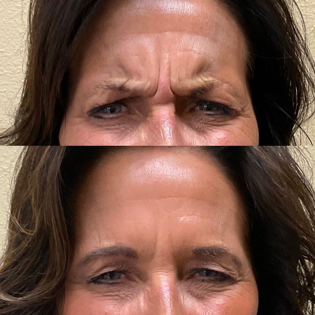 botox