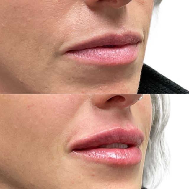 dermal filler