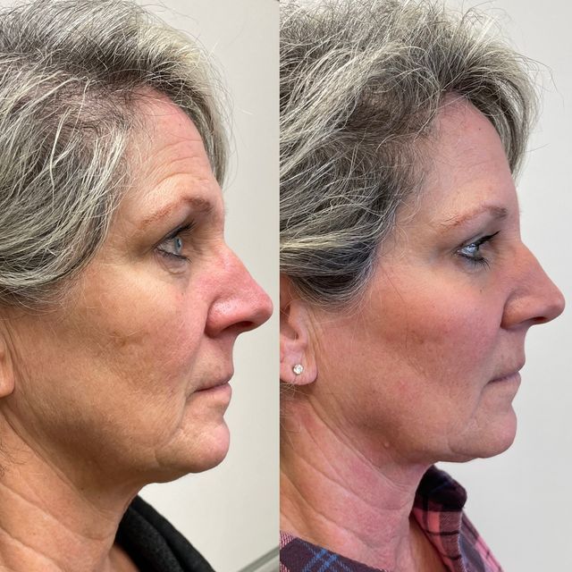 dermal filler