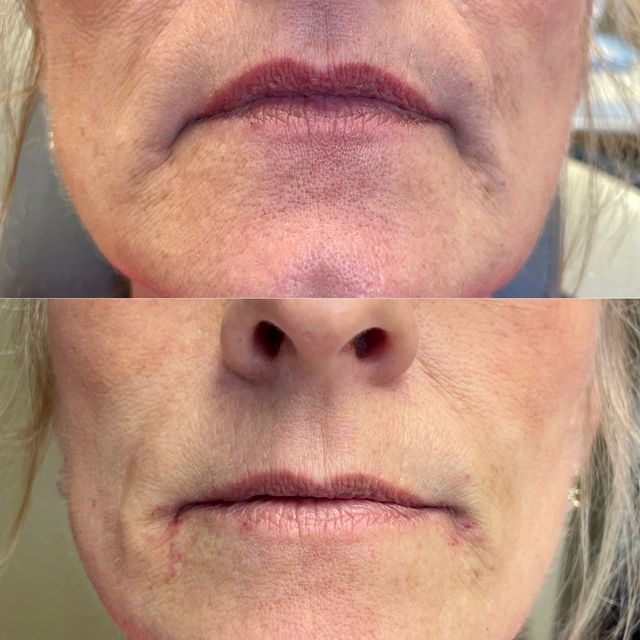 dermal filler