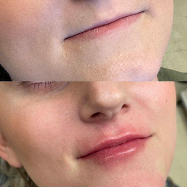 dermal filler